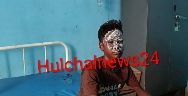 पेट्रोल छिड़ककर 10 वर्षीय बालक को जलाने का प्रयास की शिकायत ; झुलसने से गंभीर